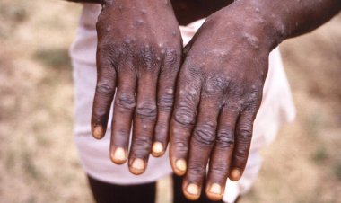 WHO launches global strategic plan to contain mpox outbreaks