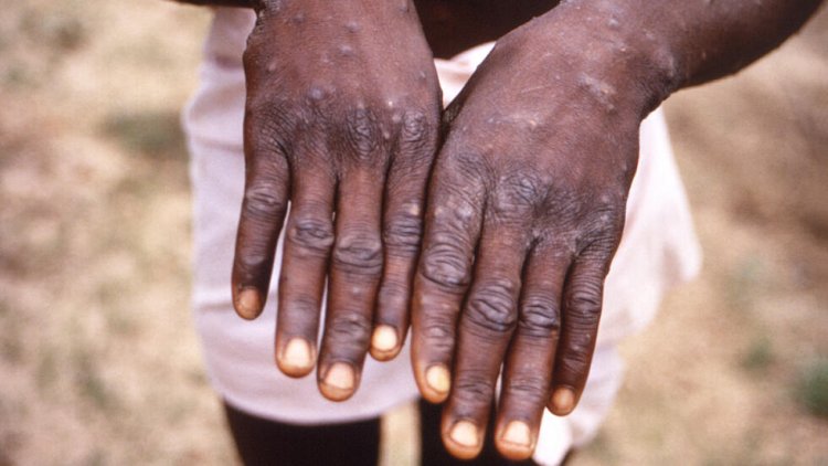 WHO launches global strategic plan to contain mpox outbreaks